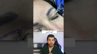 جراحة تجميلية للجفن جراحة تجميلية تجميل الجفون الليزر الكربوني Microneedling Laserco2 د مصعب حسوا 