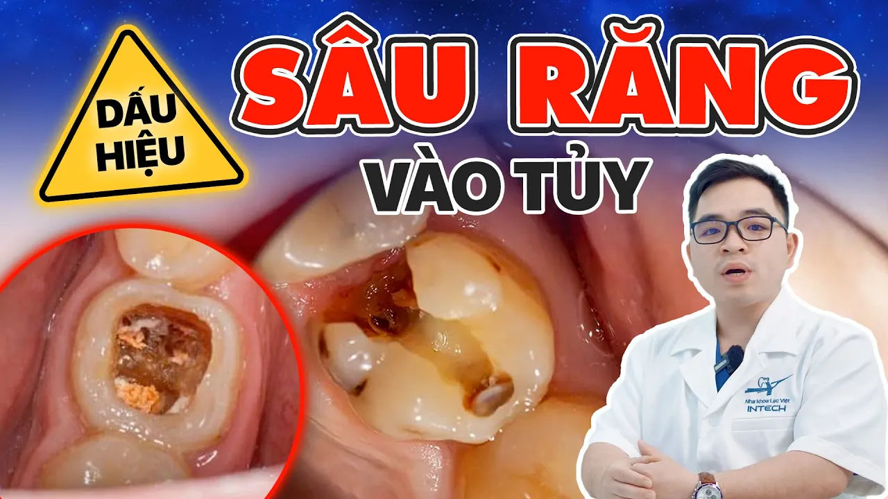 Outline Video Dấu Hiệu Sâu Răng Vào Tủy? Xử lý Sâu Răng Vào Tủy Bằng Mẹo Dân Gian Liệu Có Hiệu Quả?