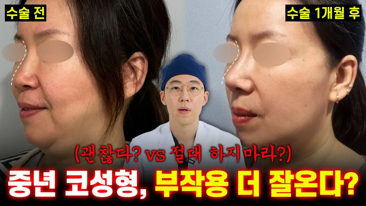 중년 코성형, 부작용 더 잘온다..? | ✨중년 코 성형 걱정 완벽 해결 영상✨