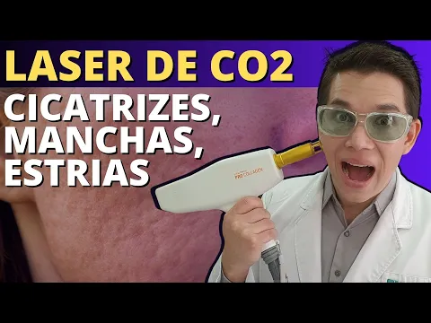 Download MP3 Laser CO2 Fracionado: CICATRIZES DE ACNE e Rejuvenescimento da Pele