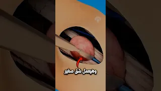 استئصال الكيس الزلالي جراحيا Shorts 