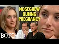 Pregnancy Nose Growth Shauna s Nose Runs After Her Nose Job Before After Botched E