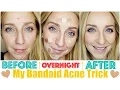 How to Get Rid of Acne Fast OVERNIGHT with My Bandaid Trick