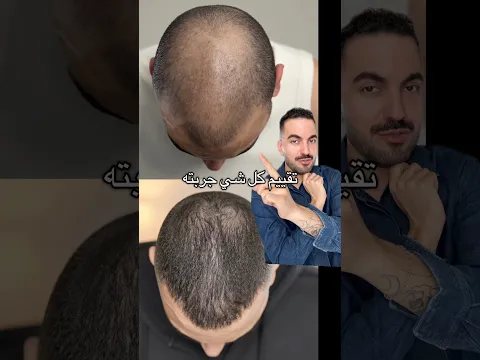 تقييم كل شي جربته لعلاج الصلع🌱