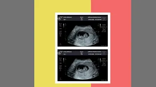 Customized Ultrasound Pictures Check our customized ultrasound WE DESIGN IT FOR YOU