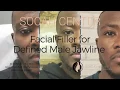 Filler for Defined Male Jawline Simple Painless Nonsurgical Procedure to Chisel Features