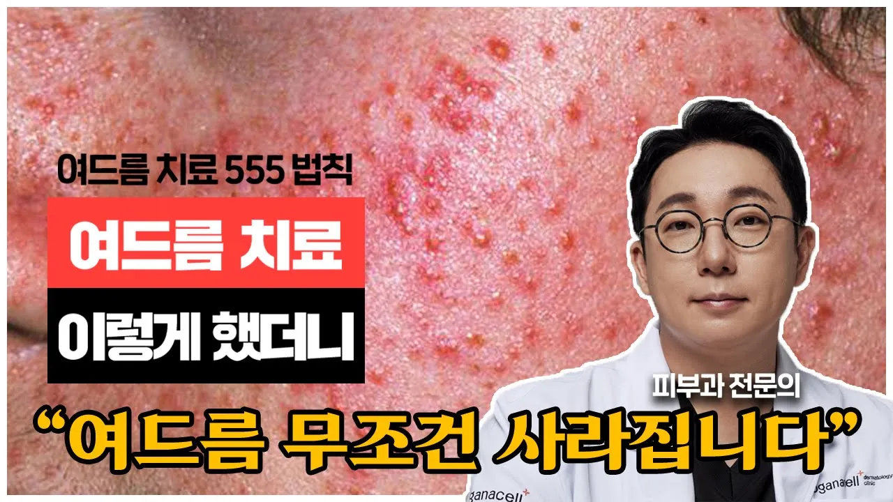 여드름 치료 포기하지마세요 "여드름 무조건 사라집니다"