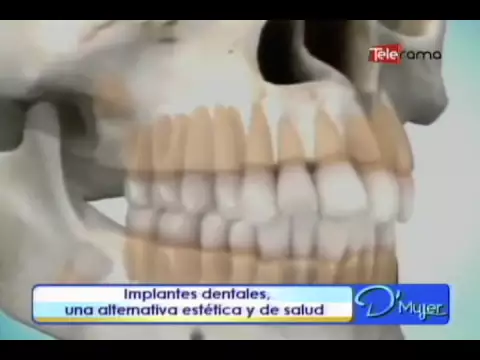 Implantes dentales una alternativa y de salud