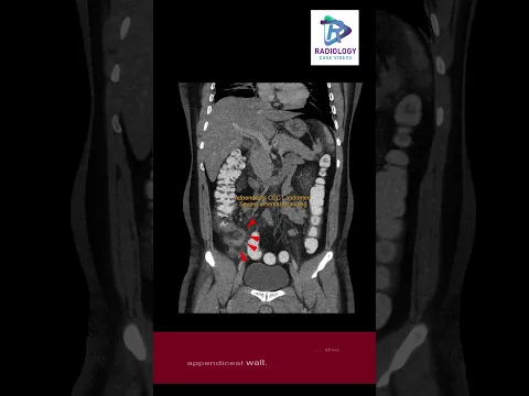 Download MP3 Acute Right iliac fossa pain : Radiology Classic case