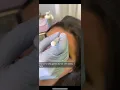 I m an LPN nurse injector and have been injecting for over 6 years now