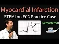 Myocardial Infarction STEMI on ECG - Practice EKG