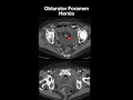Obturator Foramen Hernia Radiology Spotters
