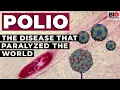 Polio The Disease that Paralyzed the World