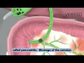 Choledocholithiasis explained