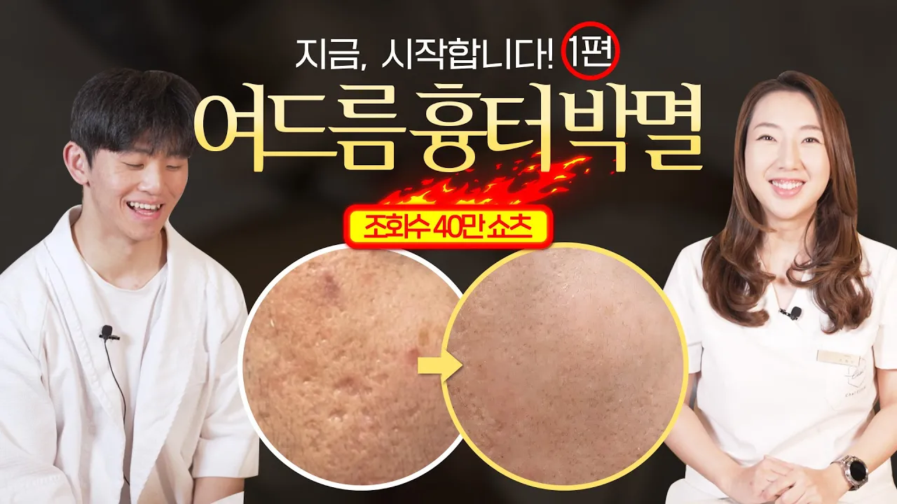 [1편] 여드름 흉터 싹을 잘라버리는 서막의 시작.. | 여드름 흉터, 흉터치료, 레이저치료 | 차이의원 조원진 대표원장