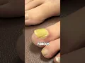 How to Remove Toenail Fungus 😷🩺🩻