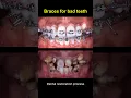 Download Lagu Restore bad teeth and braces #braces #orthodontist #dentist #teeth