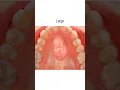 Roof of Mouth Growth Torus Palatinus fauquierent