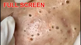 Download LARGE Blackheads Removal - Best Pimple Popping Videos MP3