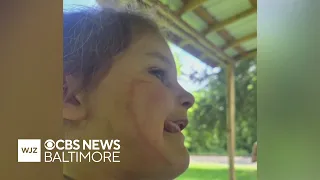 Girl stung by jellyfish in Ocean City Maryland