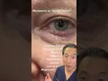 What is Myokymia or Eyelid Twitching From