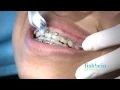 Orthodontic Home Care Instructions Braces Brushing