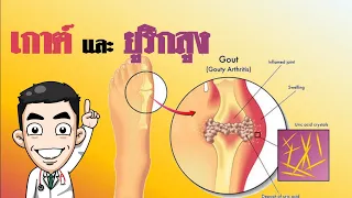 ทำไมการกินยาแก้ปวดถึงอันตรายสำหรับผู้ป่วยเก๊าท