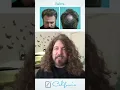 Download Lagu Hairline and Crown Hair Restoratioon
