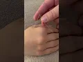 Acupuncture treatment for knee pain