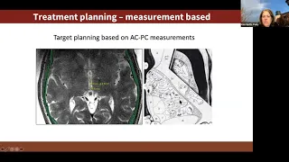 Treatment of essential tremor using high intensity focused ultrasound with Dr Pejman Ghanouni