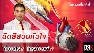 หลังจากทำสวนหัวใจแล้ว ต้องดูแลตัวเองอย่างไรบ้าง