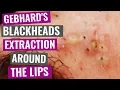 Gebhard s Blackheads extraction around the lips