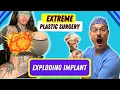 Huge Breast Implants - Extreme surgery