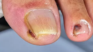Unha extremamente enterrada, veja como fiz para tirar a ponta dali #nails #satisfying