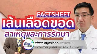 อาการของเส้นเลือดขอดมีอะไรบ้าง และควรไปพบแพทย์เมื่อไหร่