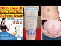 7 Days Stretch Marks Cream Reduces Stretch Marks How to Remove Stretch Marks NikGoals