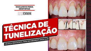Técnica da Tunelização - Cirurgia Periodontal para Recobrimento Radicular