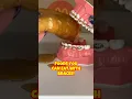 Can you eat MCDONALD S BREAKFAST with BRACES