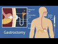 Closure of Gastrostomy CPT code - simplify medical coding