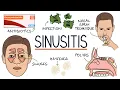 Understanding Sinusitis