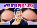 How to Treat ACNE the Holistic Way