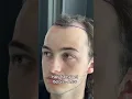 Download Lagu Hair Transplant Turkey  #hairtransplant  #hairtransplantturkey