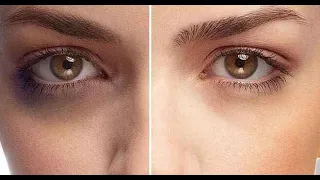 اسباب هالات السوداء تحت العين دندنها