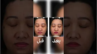 ازالة الشامات بطريقة سهلة مع الليزر              دندنها
