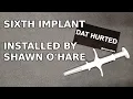 - Sixth Implant Installed