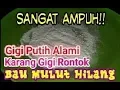 Download Lagu Cara Ampuh Menghilangkan Karang Gigi Yang Sudah Mengeras