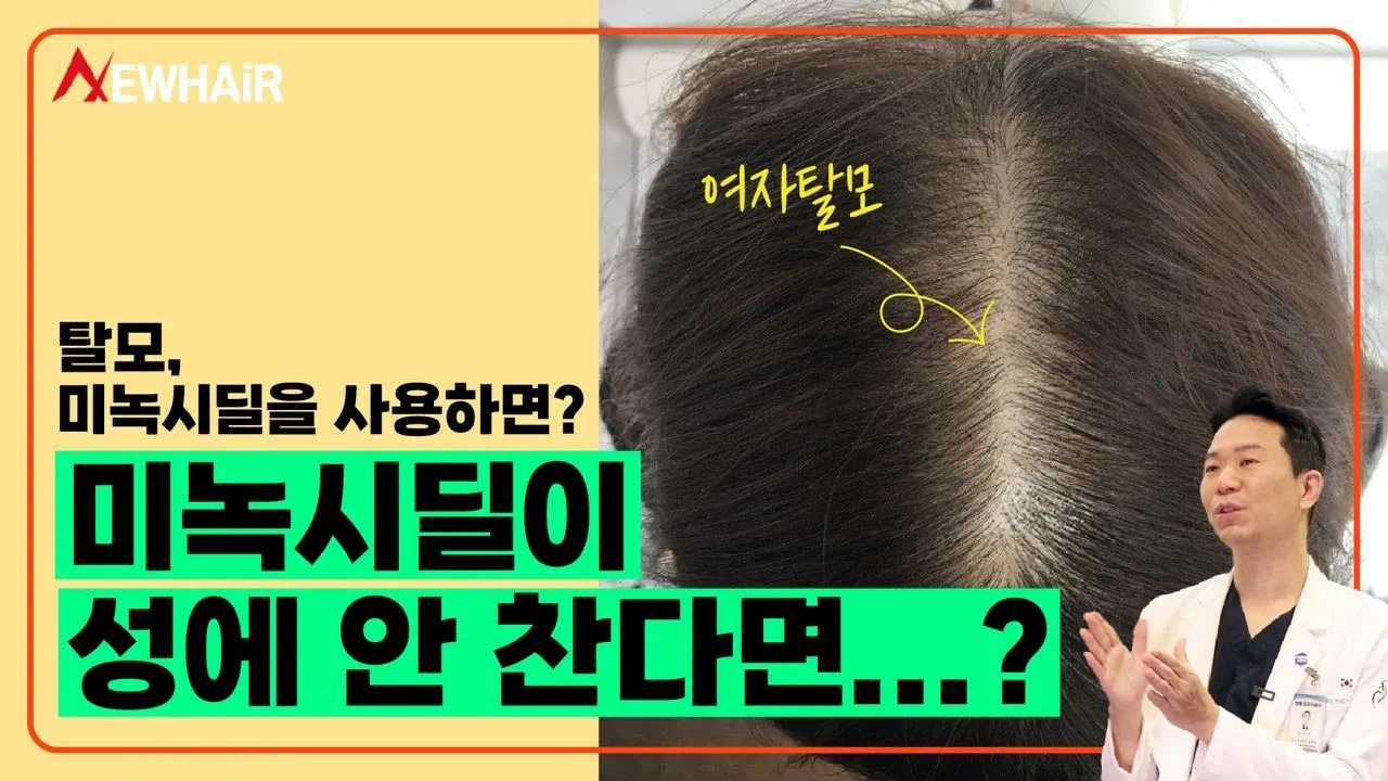 여자탈모인데 남자용 미녹시딜을 사용했을 때 이렇게 됩니다ㅣ뉴헤어