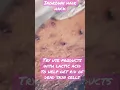 Stop ingrown hairs