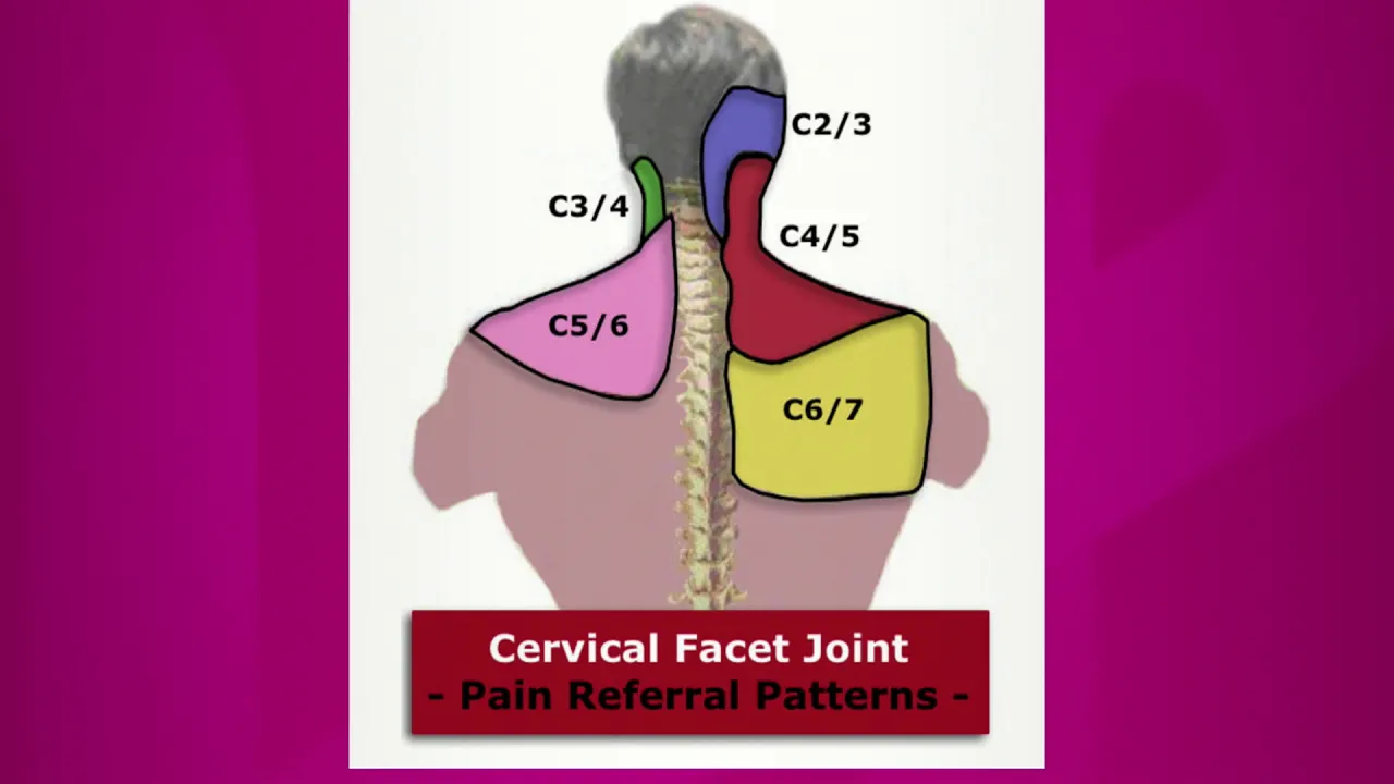 Operasi syaraf terjepit oleh dr Syafrudin SpOT (K) Spine. 