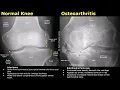 Knee X-Ray Normal Vs Osteoarthritis AP Lateral Skyline Views Knee Radiography